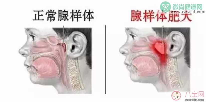 孩子睡觉张嘴打呼噜怎么回事  宝宝睡觉张嘴打呼噜怎么办