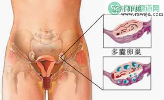 多囊卵巢成功怀孕的经历2018