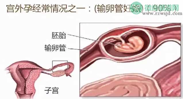 胚胎着床异常就是子宫外孕吗 怎么提早发现子宫外孕2018