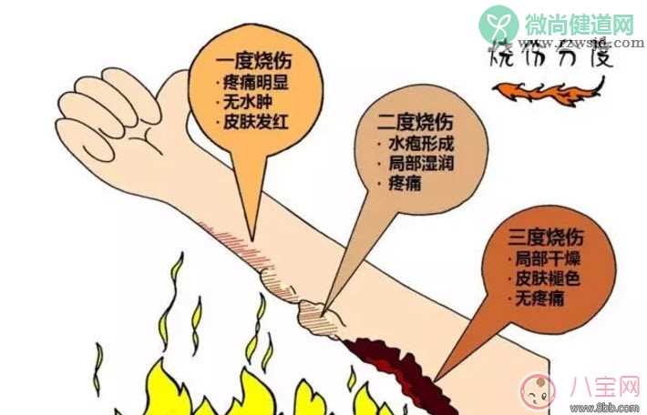 宝宝烫伤怎么办 宝宝烫伤急救处理方法