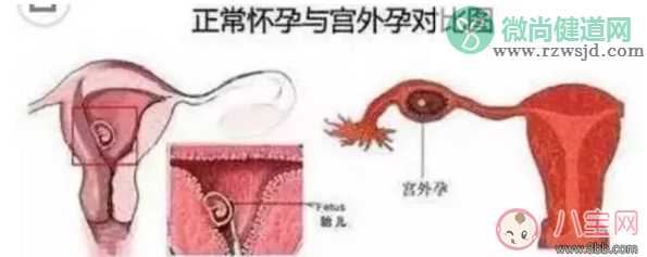 试管怀孕可以避免宫外孕吗 