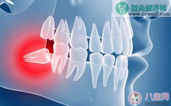 怀孕智齿一定会发炎吗 智齿一定要拔吗