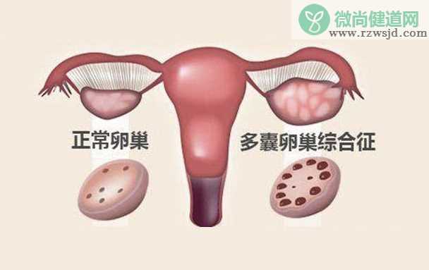 多囊卵巢综合征怀孕初期要注意什么 多囊卵巢综合征