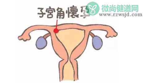 宫角妊娠回正位的办法 宫角