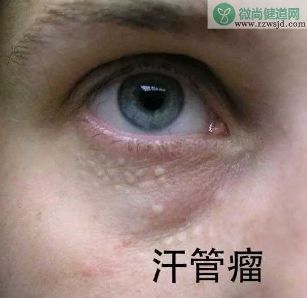 脂肪粒和汗管瘤有什么区别 如何区分脂肪粒和汗管瘤