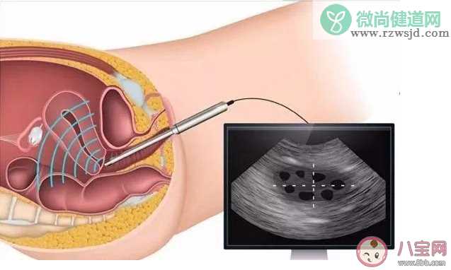 孕早期可以做阴道B超吗 孕期做阴道B超有什么好处