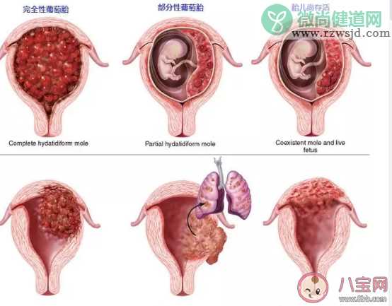 葡萄胎是什么  葡萄胎葡萄胎清宫痛吗