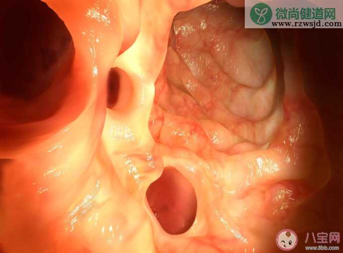 肠息肉都会癌变吗 肠息肉的类型有哪些