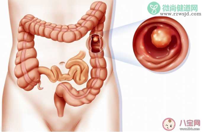 切除息肉疼不疼 肠息肉切除