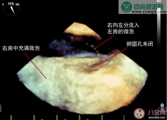 长期偏头痛要注意卵圆孔未闭 卵圆孔未闭需要手术吗