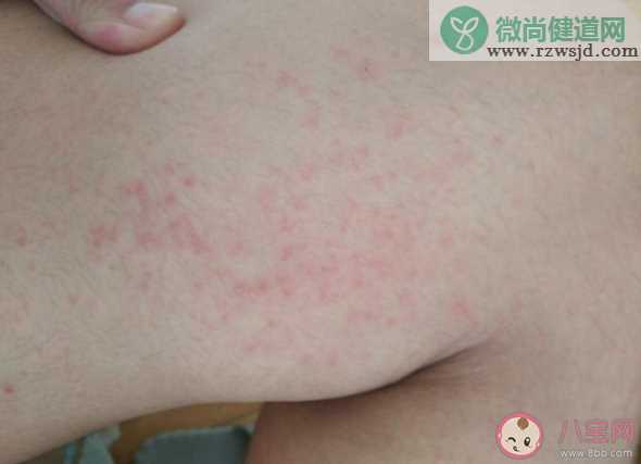 大腿内侧瘙痒的原因是什么 什么情况下要就诊