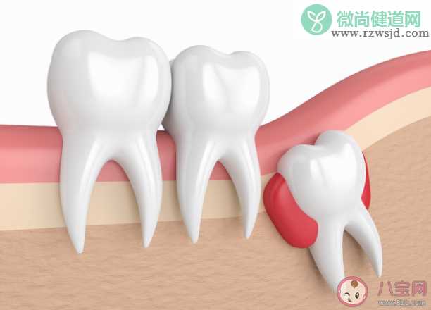 智齿是如何被拔出的 哪种智齿必须要拔