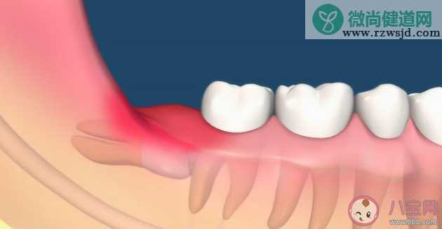 智齿是如何被拔出的 哪种智齿必须要拔