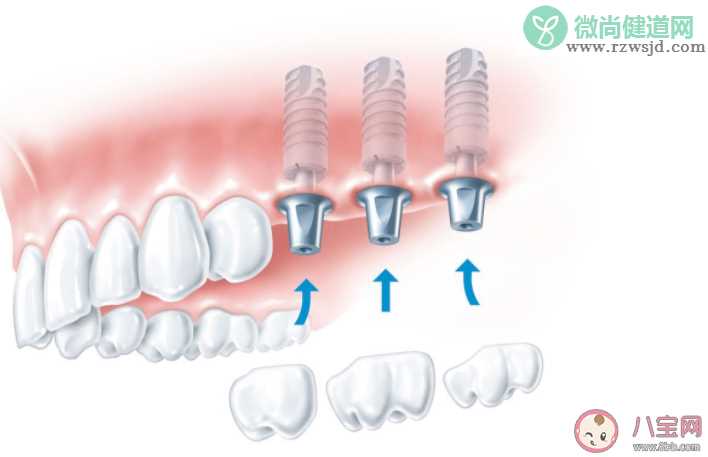 种植牙就要选最贵的吗 种植牙如何护理