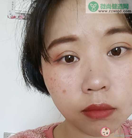 女性脸上雀斑是怎么形成的 雀斑有效检查方法是什么样的