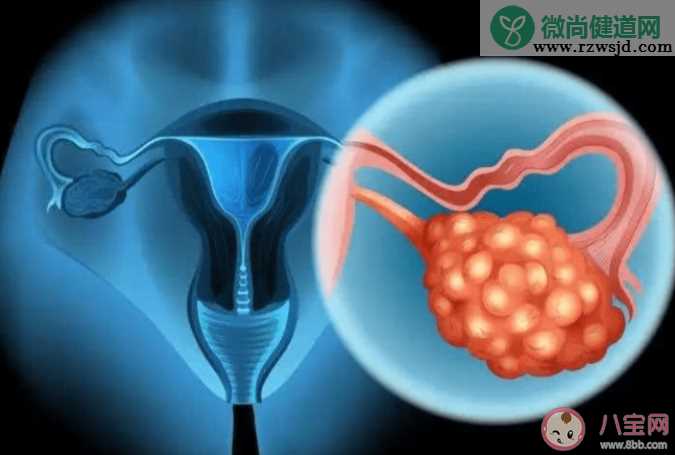 约70%卵巢癌患者确诊已是晚期 为什么卵巢癌难以发现