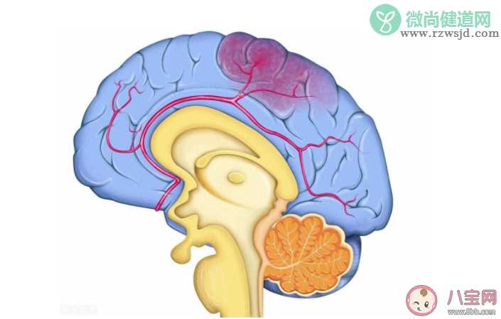 哪些人是脑出血高危人群 突