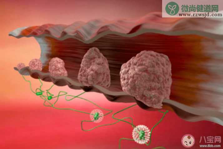肠息肉切掉了为什么 还会复