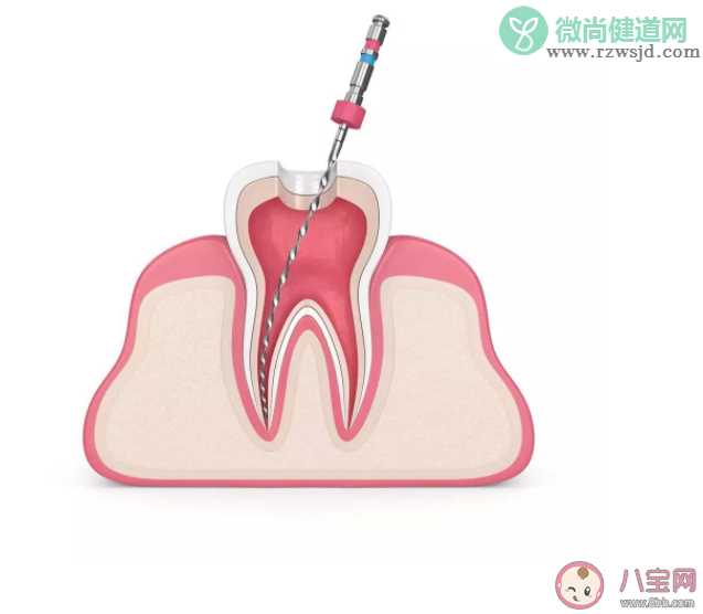 根管治疗后为什么还需要做牙