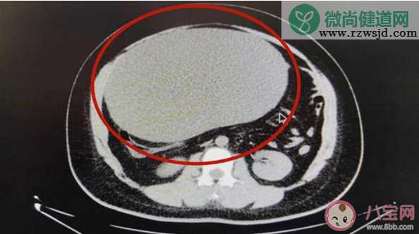 女子以为发胖肚中取出16斤囊肿 卵巢囊肿有哪些症状