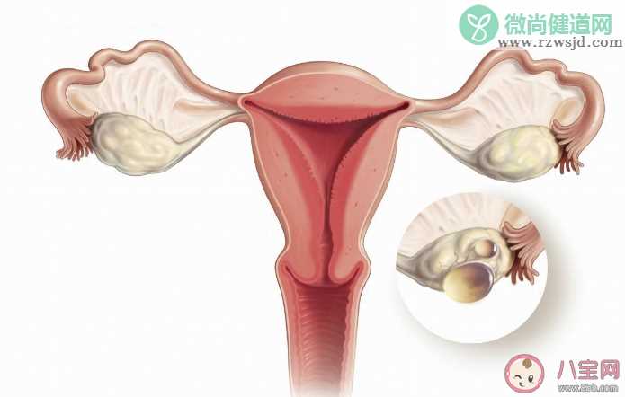 女子以为发胖肚中取出16斤囊肿 卵巢囊肿有哪些症状
