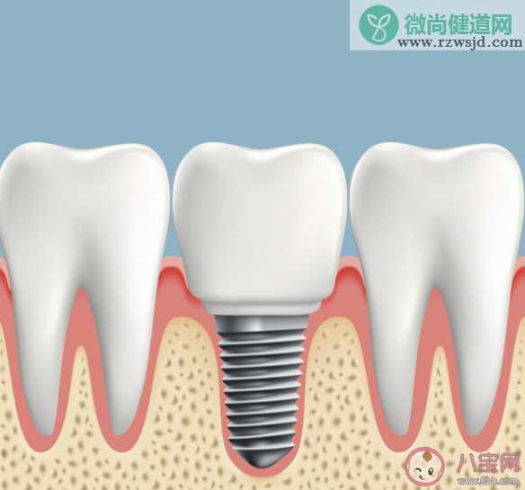 怎样提高国产种植牙使用率 关于种牙你了解多少