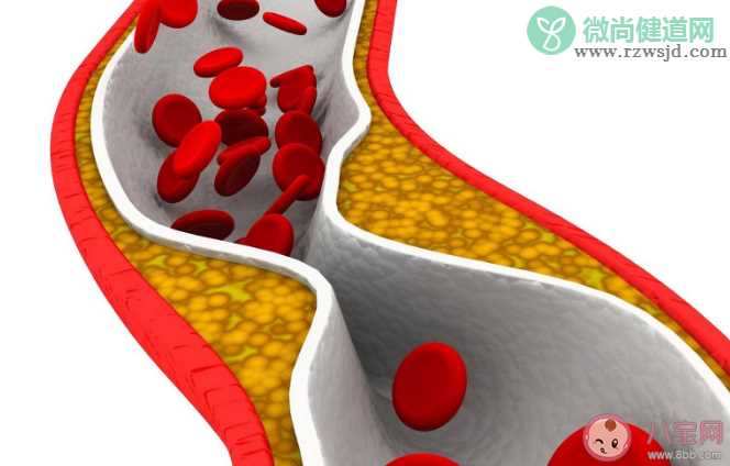 6种食物易导致动脉粥样斑块 动脉粥样硬化形成主要经过哪几步