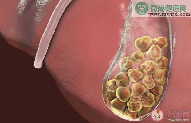 胆结石会不会变成癌 预防胆
