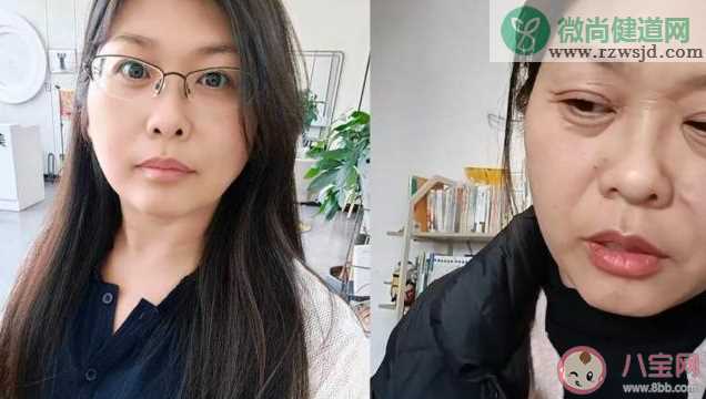 42岁女子20天断崖式衰老是怎么回事 为什么会出现断崖式衰老