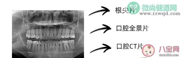 看牙为什么要拍片 口腔科中的拍片类型包括哪些