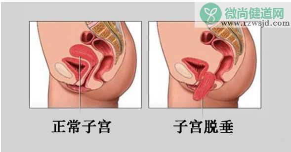 怀孕后发现子宫脱垂怎么办 