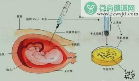 产前诊断有哪些项目   产前诊断项目介绍