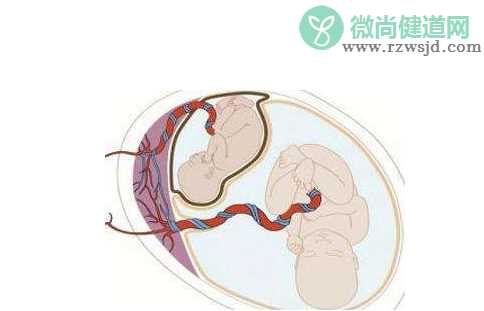 帆状胎盘有什么危害 帆状胎盘是什么原因引起的