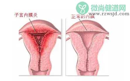 子宫内膜炎怎么检查出来 慢性子宫内膜炎要做哪些检查