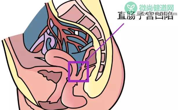 病理性盆腔积液会痛经吗 为