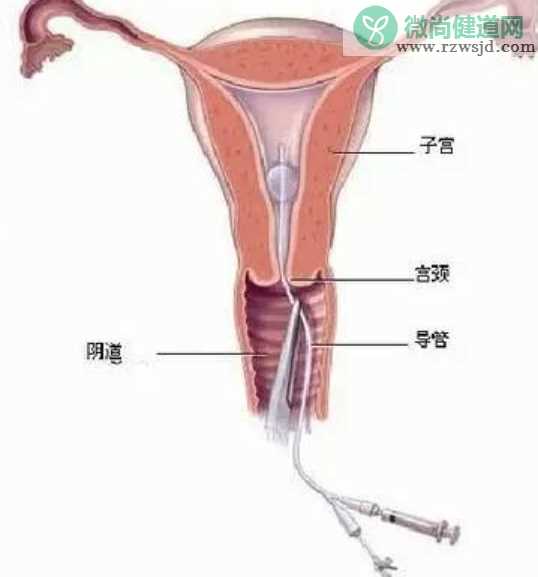 宫腔镜检查疼不疼 宫腔镜检查能检查哪些疾病