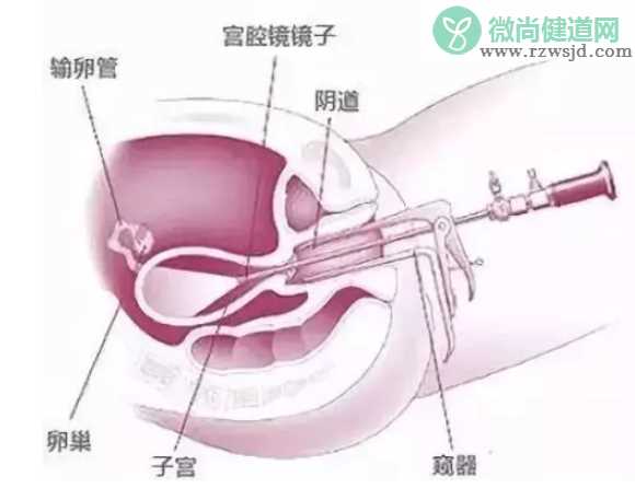 宫腔镜检查疼不疼 宫腔镜检查能检查哪些疾病