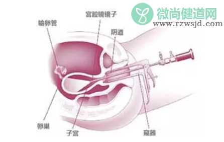 电刀手术对内膜损伤大真的吗 宫腔镜电刀手术安全吗