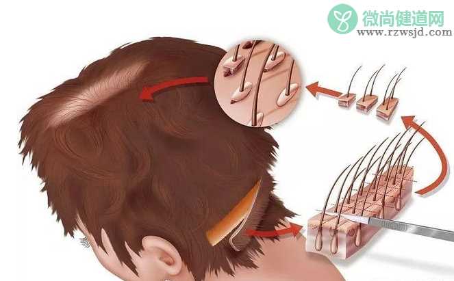 植发后多久能长出头发 植发后还会脱发吗