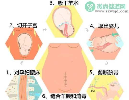 剖腹产后排不了气怎么办 剖腹产后怎么帮助排气