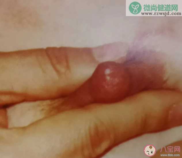 喂奶后乳房出现了针扎样的疼