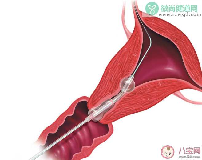 输卵管粘连还能自然受孕吗 输卵管粘连怎么治疗最有效