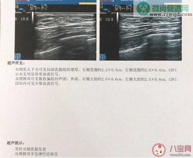 小伙健身3个月乳房发育是怎么回事 健身可以吃增肌营养粉吗