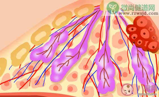 查出乳腺小叶增生会癌变吗 一分钟乳房自检方法