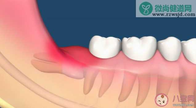 智齿没疼过也要拔吗 为什么智齿那么疼