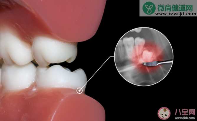 智齿没疼过也要拔吗 为什么智齿那么疼