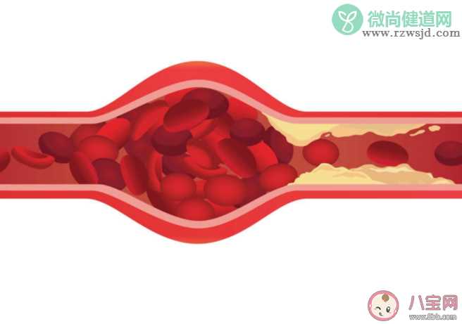 血液粘稠高有什么症状信号 血液粘稠怎么调理