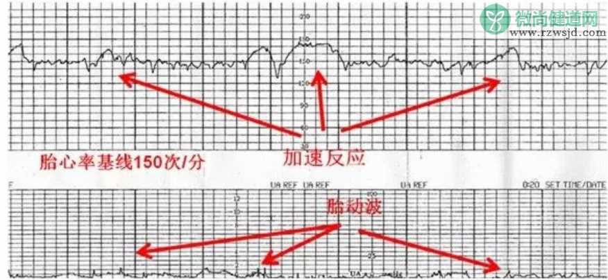 B超单上能看出打了几次胎吗 如何看孕期B超单