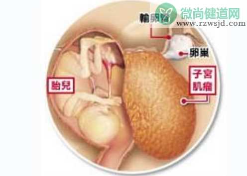 怀孕子宫肌瘤的常见症状 子宫肌瘤会引起不孕症吗