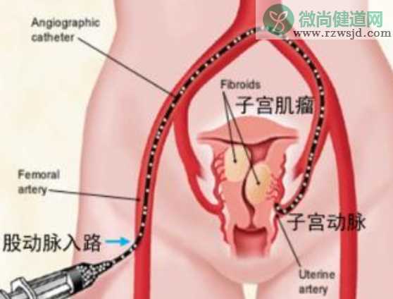 子宫肌瘤对怀孕的影响 子宫肌瘤会导致流产早产吗